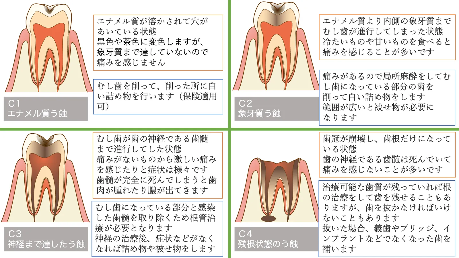 むし歯の進み方（C1〜C4）を歯の断面で示した図