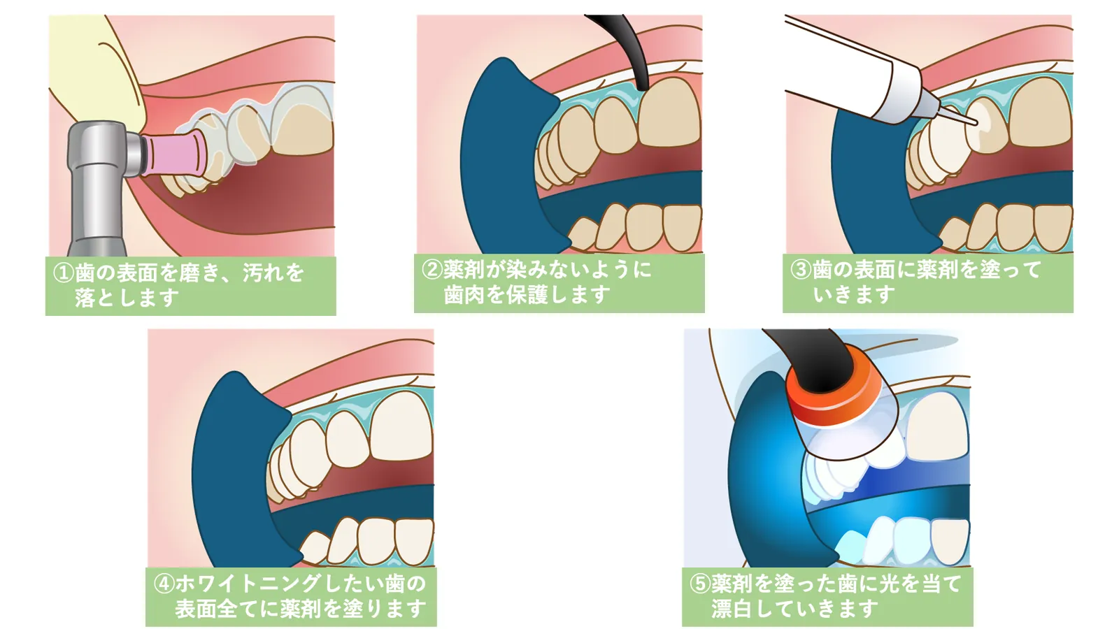 ホワイトニングの手順（歯の清掃・歯ぐきの保護・薬剤の塗布・光の照射）を示した図