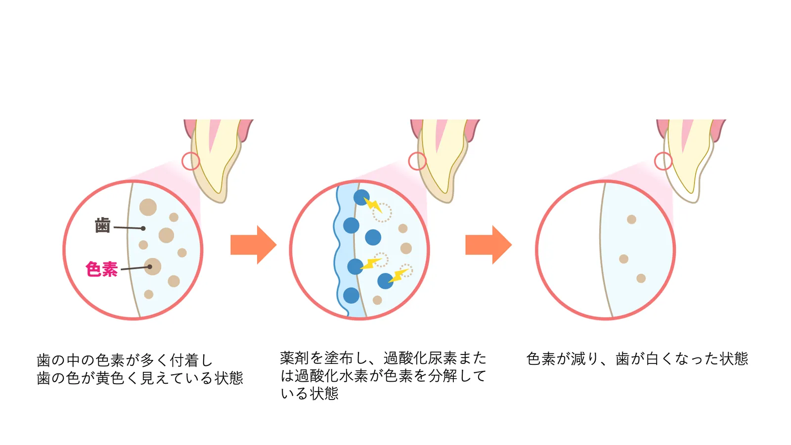 ホワイトニングの薬剤で歯の色素が分解されるしくみを示した図