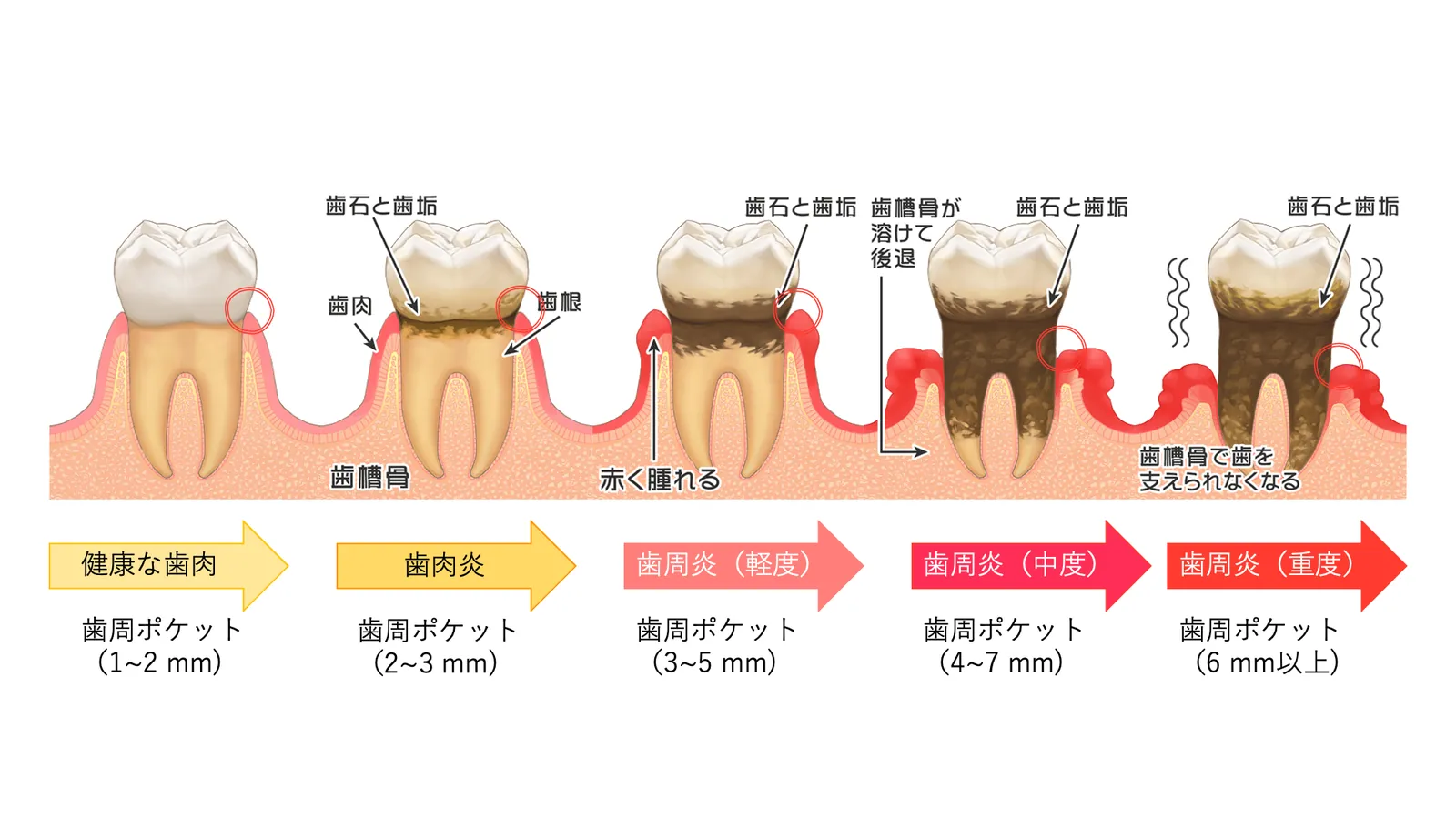 歯周病の進行（健康な歯ぐきから重度まで）と歯周ポケットの深さを示した図