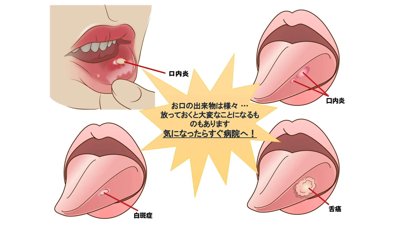 お口の粘膜にできる病気の例を示した図