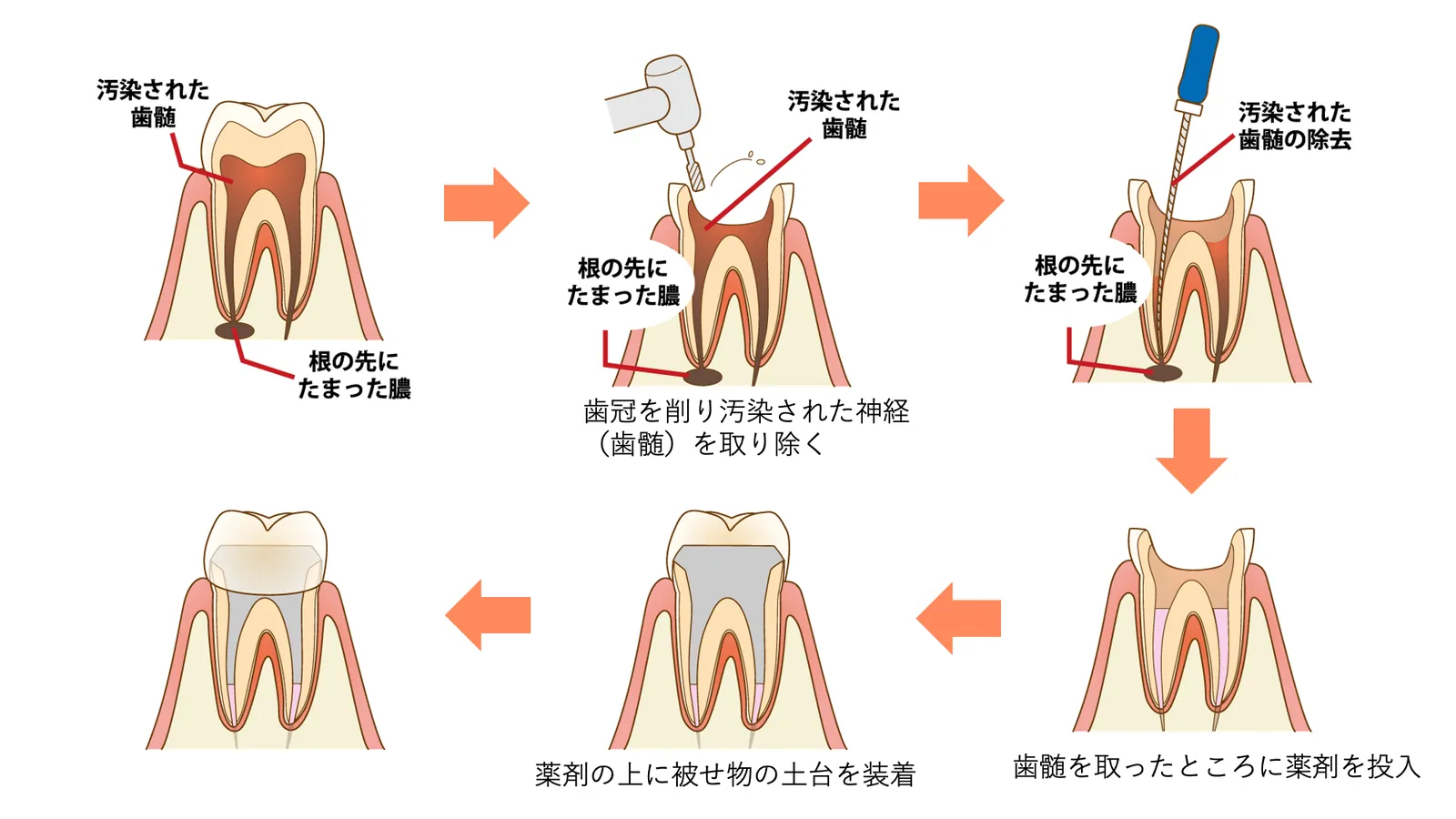 根管治療の流れ（感染した神経の除去から被せ物まで）を示した図