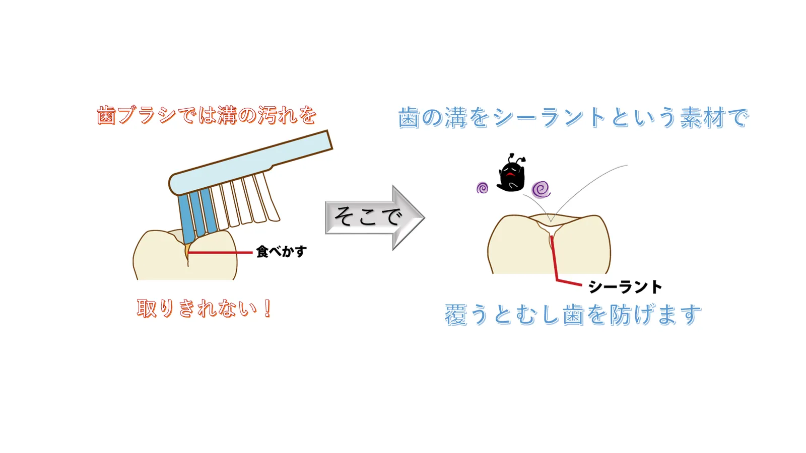 シーラントで奥歯の溝をふさぐ様子を示した図