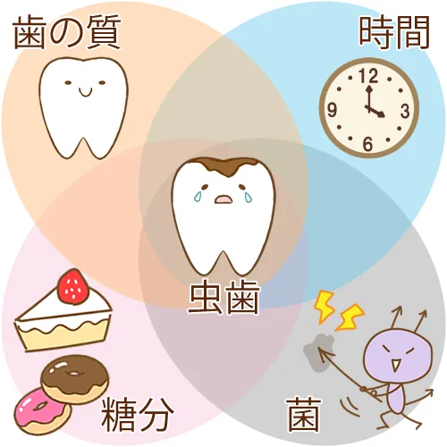 むし歯ができる4つの条件（歯の質・細菌・糖分・時間）を示した図